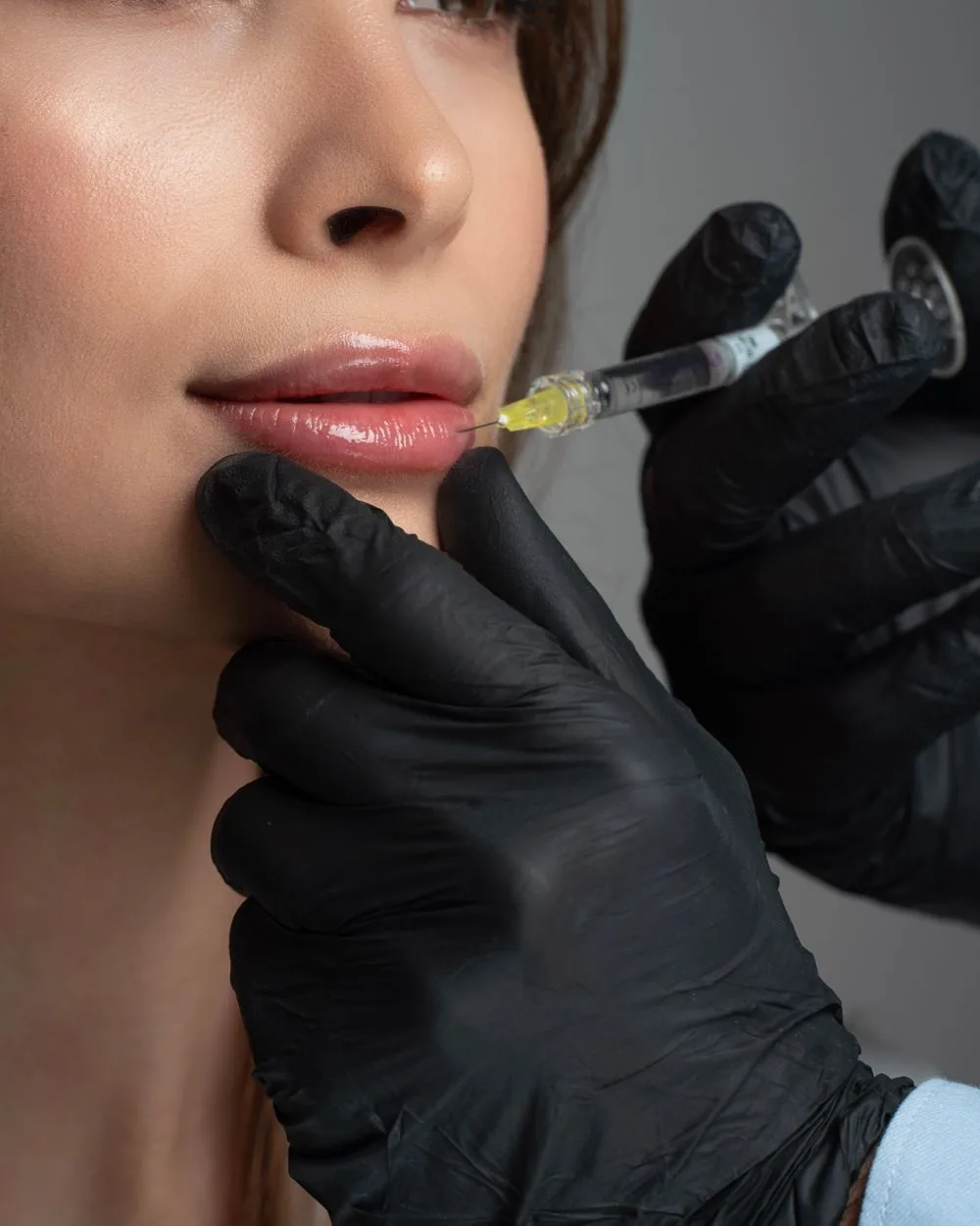 A clinician injecting hyaluronic acid filler into a patient’s lower lip.