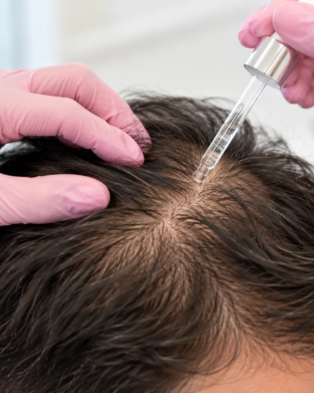 Gloved hands applying a topical solution to a parted scalp with a dropper.
